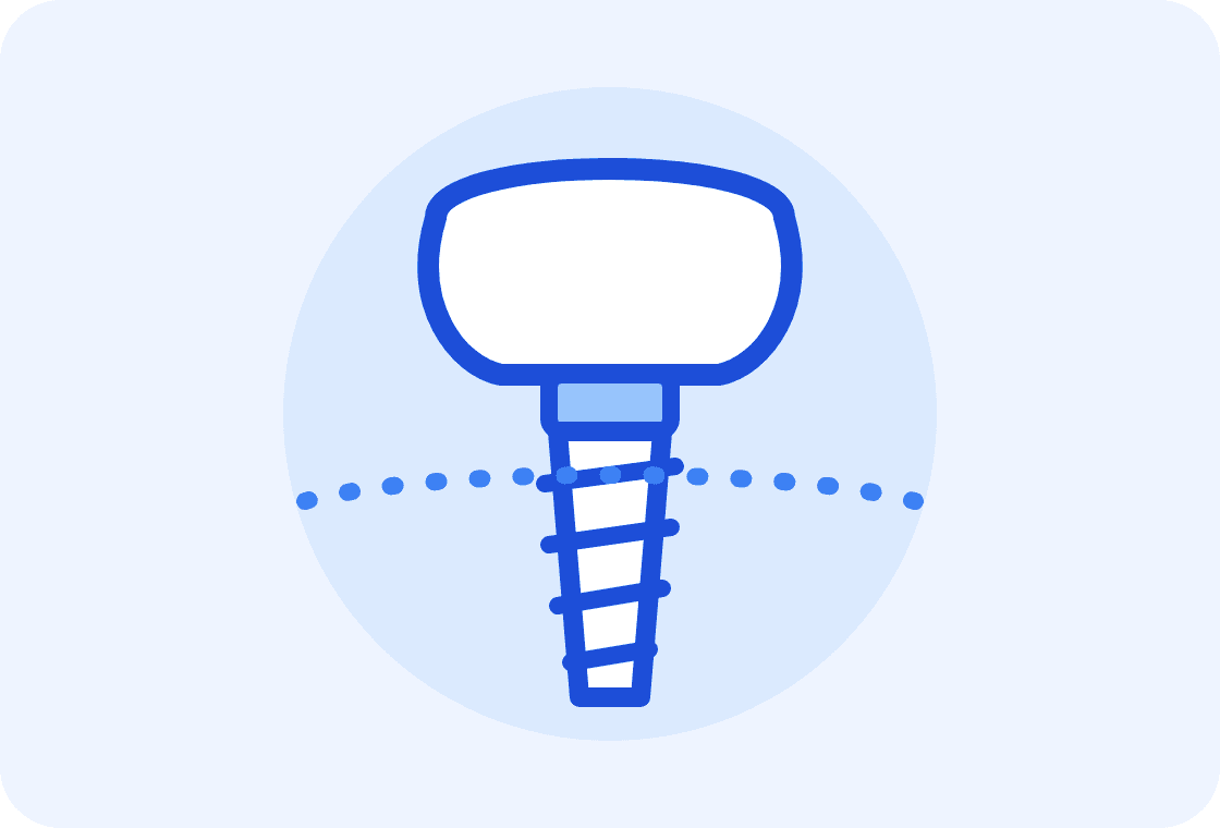 Illustration of a dental implant